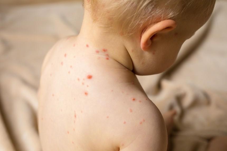 Cảnh giác với nhiều dịch bệnh mùa xuân