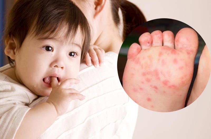 Bệnh tay chân miệng: Nguyên nhân dấu hiệu nhận biết và cách điều trị